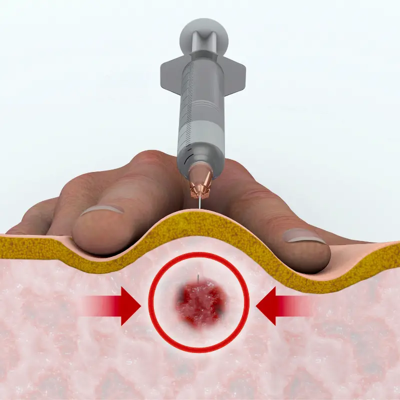trigger point injection to relieve back and neck pain trigger point injection to relieve back and neck pain